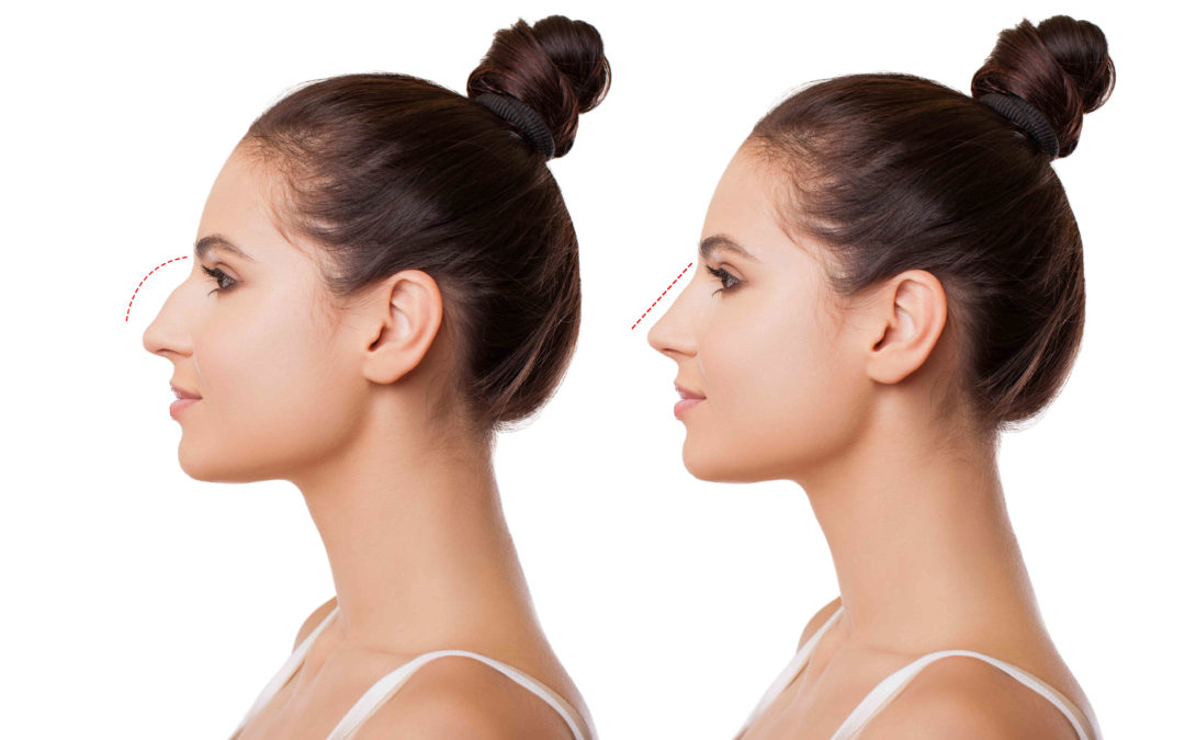 Ρινοπλαστική vs Fillers στη μύτη