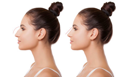 Ρινοπλαστική vs Fillers στη μύτη