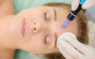 Microneedling – Όσα πρέπει να γνωρίζετε
