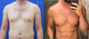 Before-After